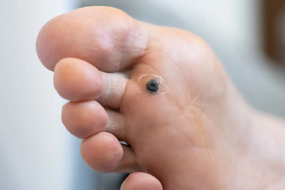 Plantar Wart: Unraveling the 'Fish Eye' and the Importance of Specialized Treatment