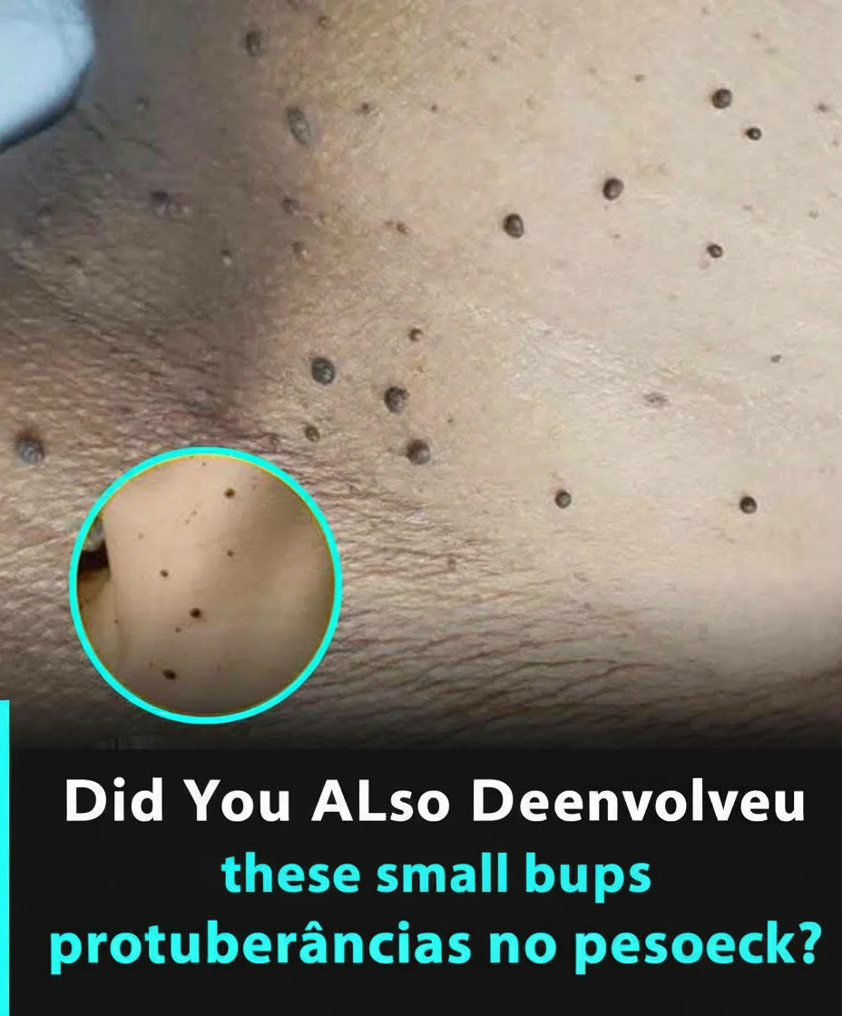 Unraveling Acrochordons: Six Common Reasons for the Appearance of 'Skin Tags', According to Experts