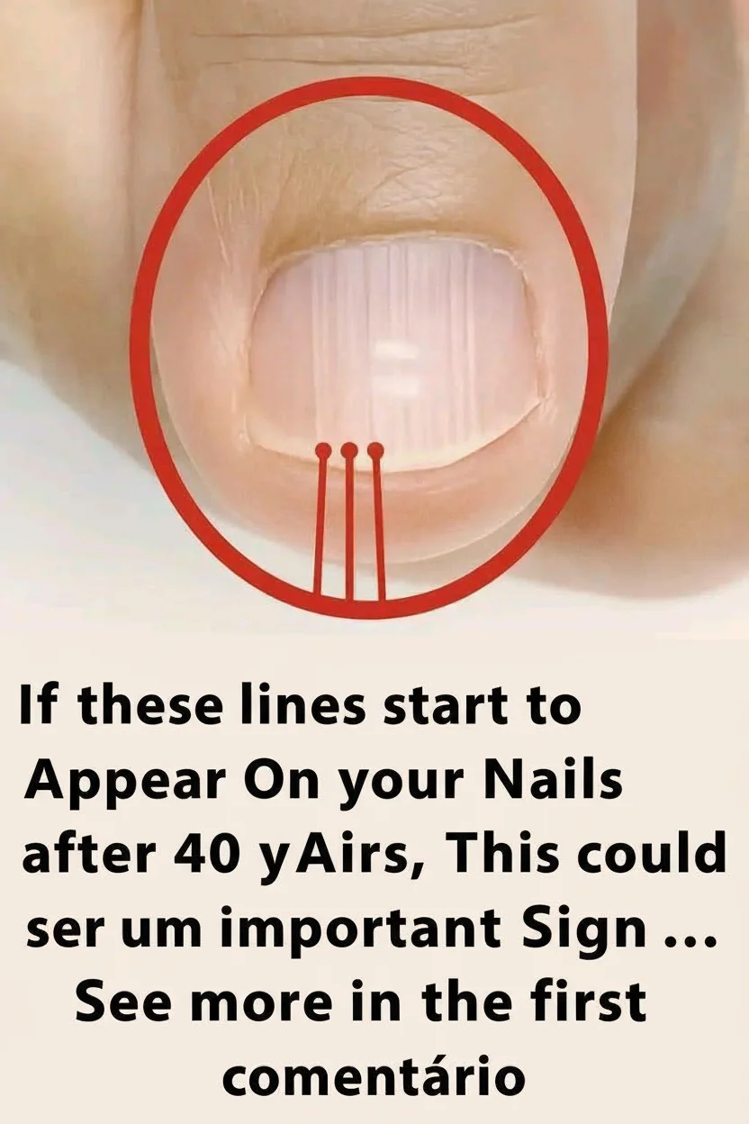 If Lines Start Appearing on Your Nails After Age 40, It Could Be a Warning Sign…