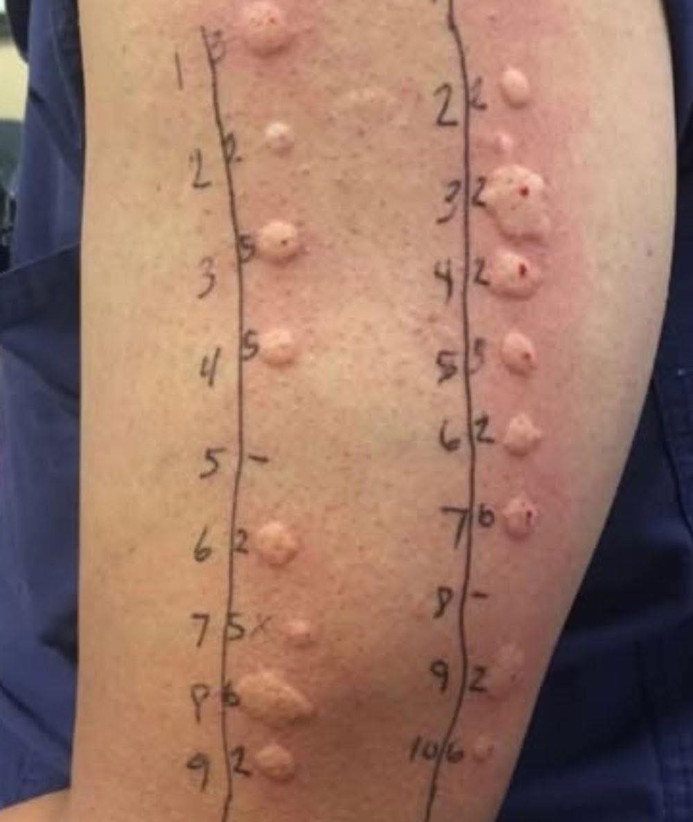 Woke Up to This on Your Skin? Here's What It Could Mean and When to Be Concerned