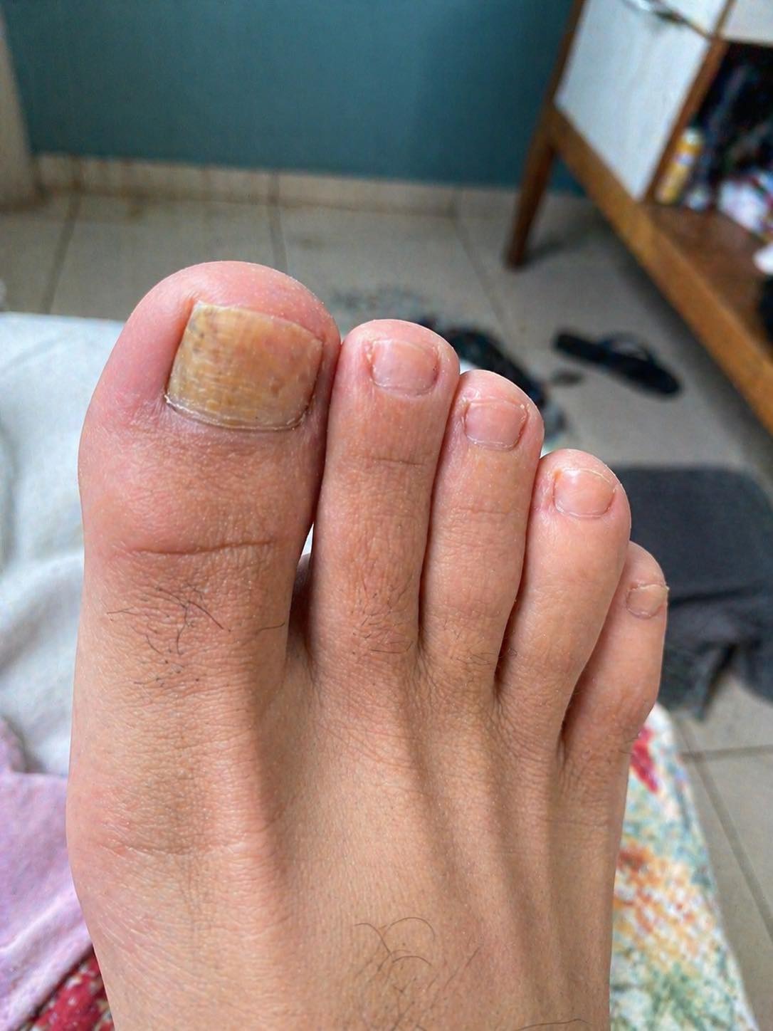 Say Goodbye to Nail Fungus with This Simple Natural Remedy