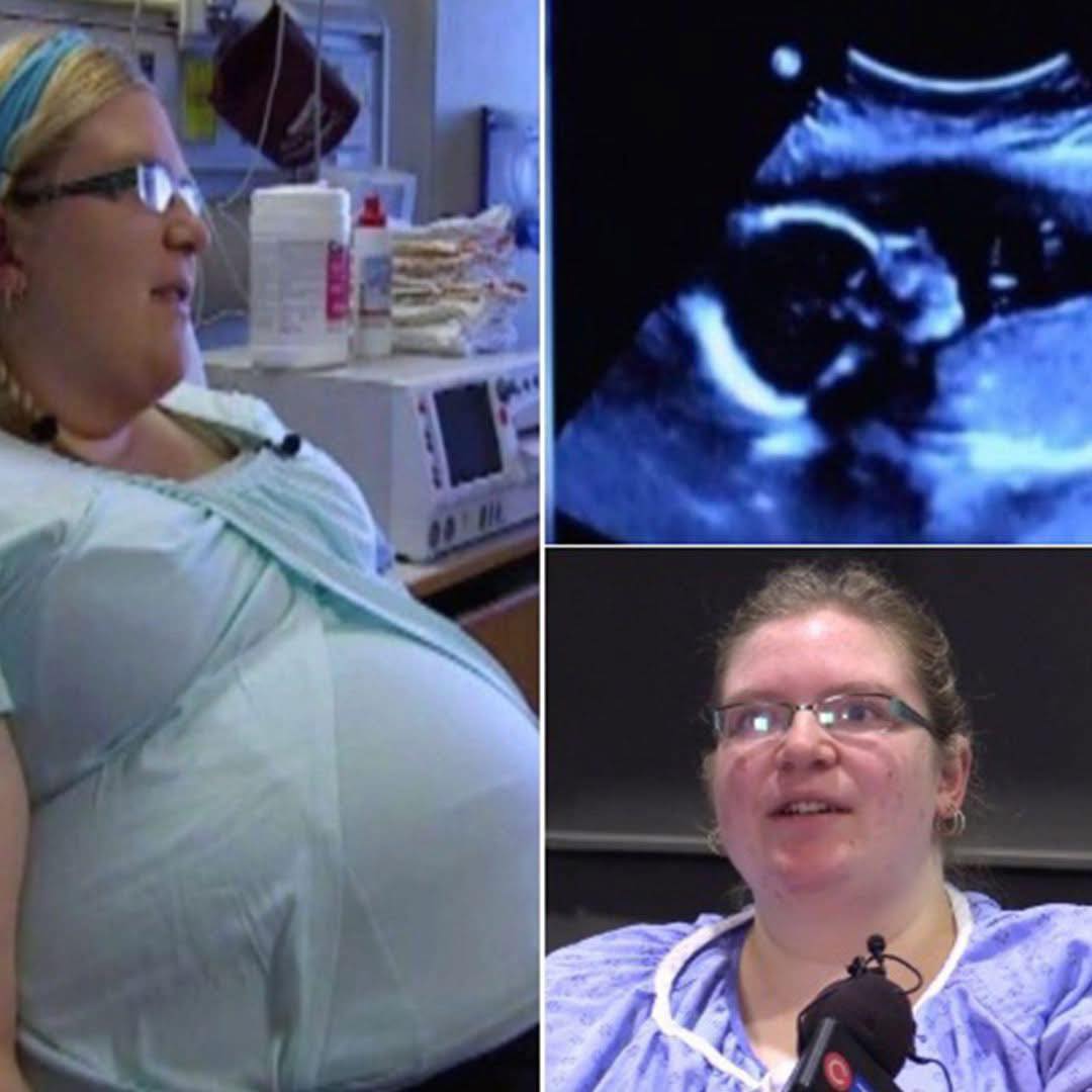 Couple Stunned by Ultrasound Discovery: A 1 in 15 Million Rarity