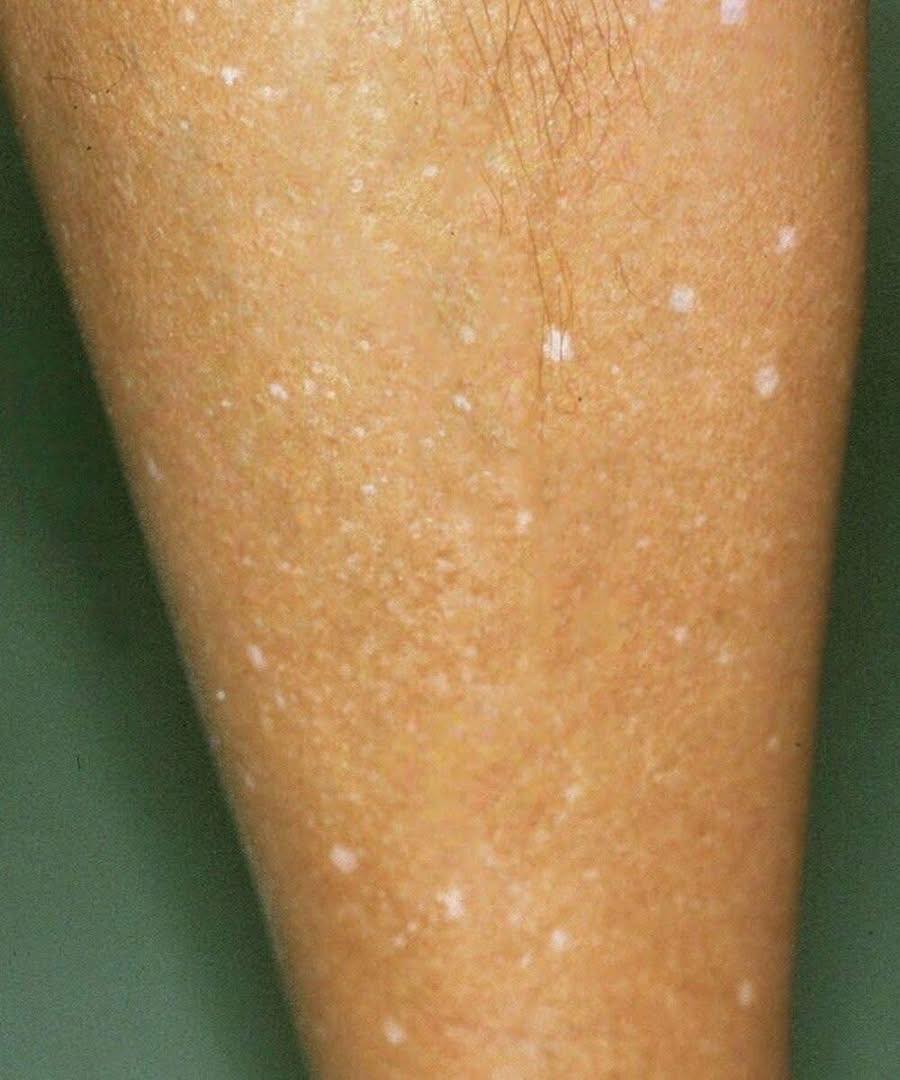 What Could Be Causing White Spots on Your Skin? Uncovering the Potential Reasons