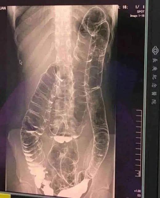 Impacted Colon: When Your Body Sends Warning Signs