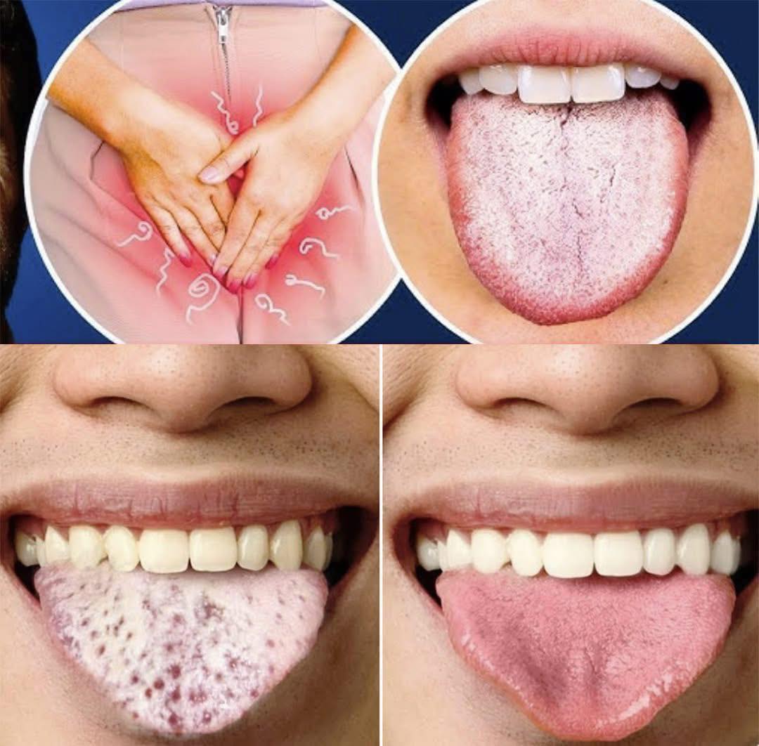 White Tongue, Fatigue, and Insomnia: What Do These Symptoms Indicate?