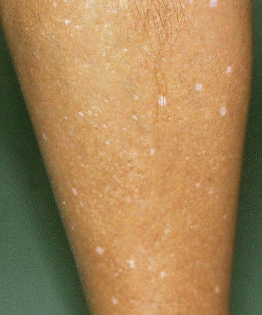 What's Behind White Spots on Your Skin? Exploring the Possible Causes