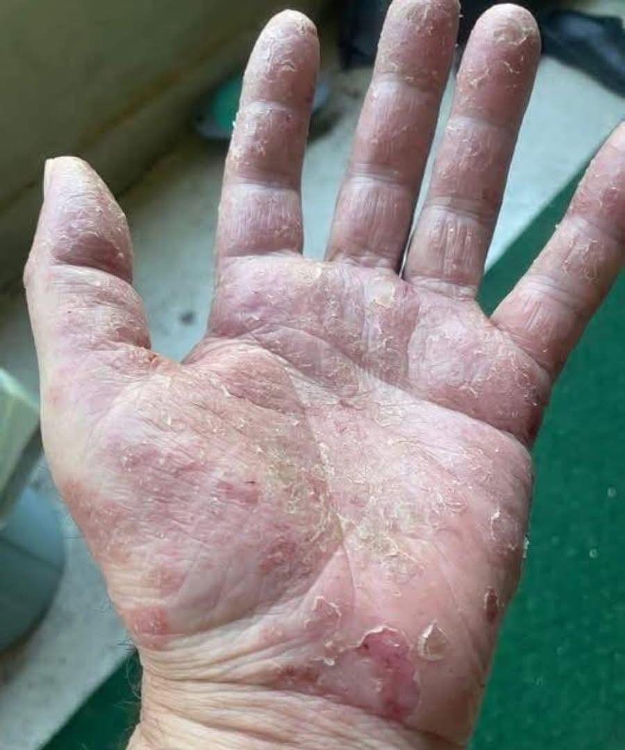 Watch Out if This Appears on Your Hands! Don't Ignore These Warning Signs